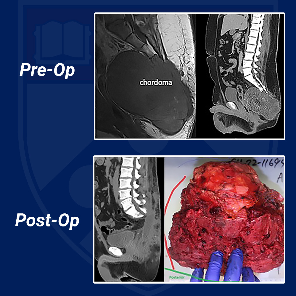 Chordoma Clinical Brief Pre and Post Surgery